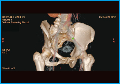 }13@Ǘ9Fq{̂pOSPECT/CT-eCTt[W摜
