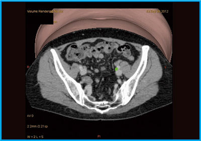 }14@Ǘ9FSPECT/CT-eCTt[W3Df