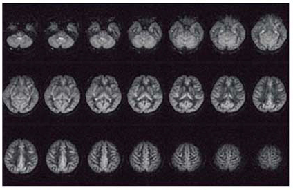 図3 pCASL法を用いた3T MRIによる全脳のパーフュージョン画像