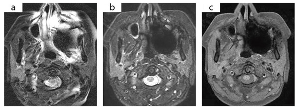 図1 IDEALによる頭頸部の脂肪抑制画像