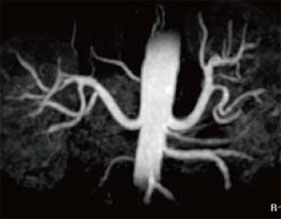 図2 Inhance による非造影MRA