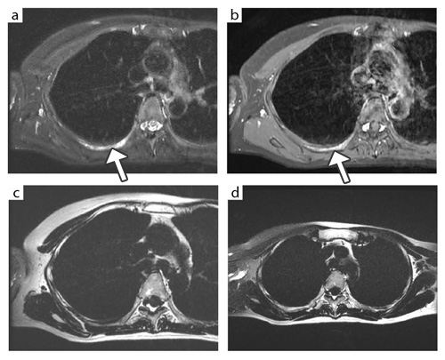 図4 IDEALによる胸郭の脂肪抑制画像