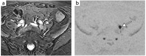 図5 体幹部の拡散強調像:子宮頸がんの腸骨リンパ節転移(再発)