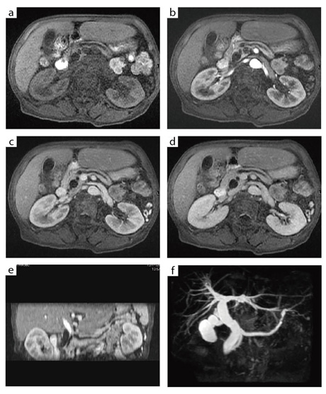 図6 LAVA によるダイナミック造影3D画像とMRCP