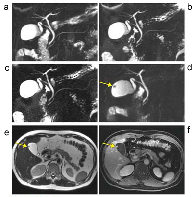 図5 胆嚢ポリープ