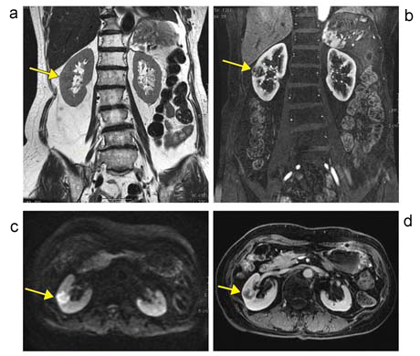 図6 直腸がん腎転移
