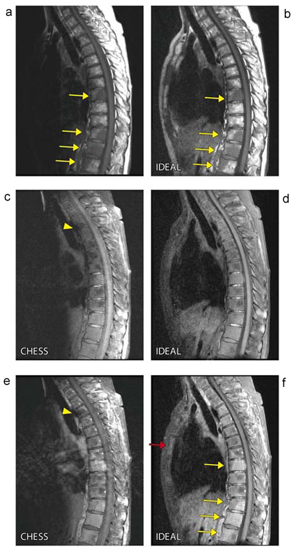 図8 悪性リンパ腫,多発性骨病変