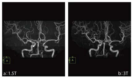 図2 3Tと1.5TにおけるTOF法を用いたMRAの比較