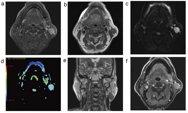 図3 左耳下腺下極のワルチン腫瘍