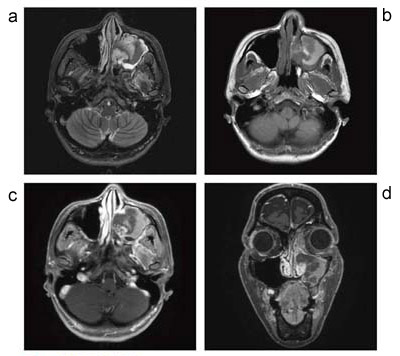 図4 左上顎洞血瘤腫
