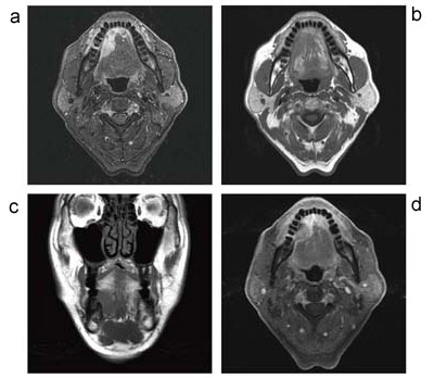 図5 口腔底腫瘍