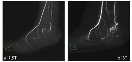 図6 3Tと1.5Tにおける左足背の血管奇形の描出能の比較(4D MRA)