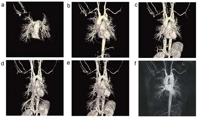 図7 本体内蔵のボディコイルとTRICKSによる大動脈縮窄症の胸腹部4D MRA(Volume Rendering表示)