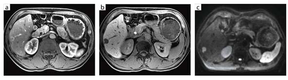 図1 B型慢性肝炎に生じた肝細胞がん(32chボディアレイコイル)