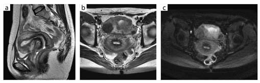 図4 多発性子宮筋腫(32chボディアレイコイル)