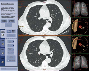 }3@3Dł̉ߋ摜Ƃ̔r\Lung VCAR
