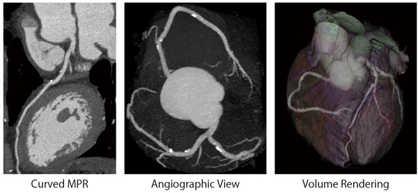 }4@΂SBeP[X SnapShot Pulse/ASiR/100kVp/275mA/0.35sec