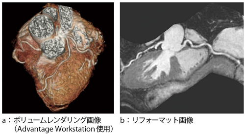 図5　3D Heartによる高精度冠動脈撮像 （画像ご提供：横浜栄共済病院様ほか）