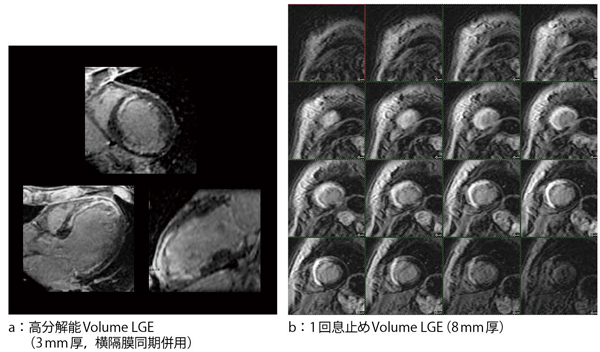 図7　3D Heartによる高精度Volume LGE撮像 （画像ご提供：市立旭川病院様）