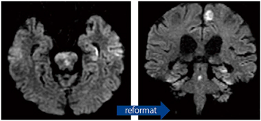 }2@72bŎB1.8mmXCXVolume DWI
