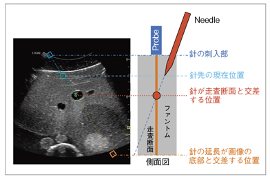 }4@Off-Plane Needle Tracking̉摜\