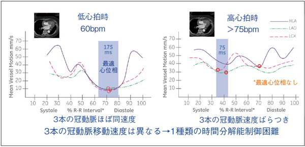 図1 心周期による冠動脈移動速度の変化