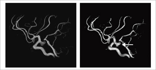 症例2:破裂脳動脈瘤