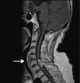症例3:頸髄腫瘍