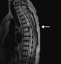 症例3:未破裂動脈瘤右頸部から頭部にかけて痛みがあり,MRIを撮像。