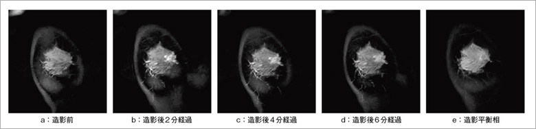 症例1:乳頭腺管癌