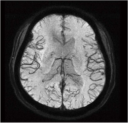 図2 Multi-Shot RSSG EPI MinIP画像
