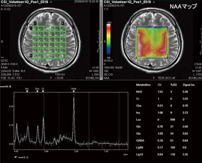 }4@CSIiChemical Shift Imagingj