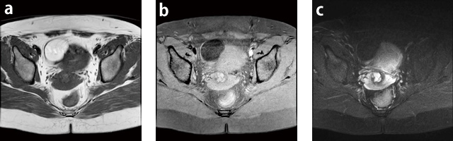 症例1:右卵巣delmoid cyst