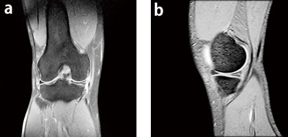 症例2:右内側半月板損傷右膝疼痛と軽度の関節腫脹があり,MRIを撮像。