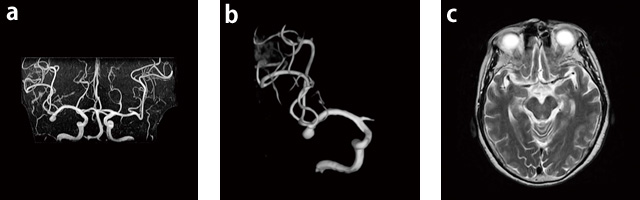 症例3:未破裂動脈瘤右頸部から頭部にかけて痛みがあり,MRIを撮像。