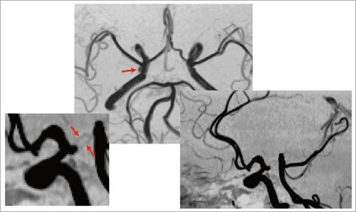 図4 3D TOF(脳動脈瘤)
