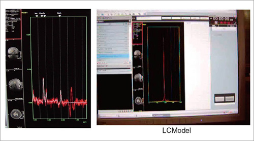 図10 MRSのデータ解析