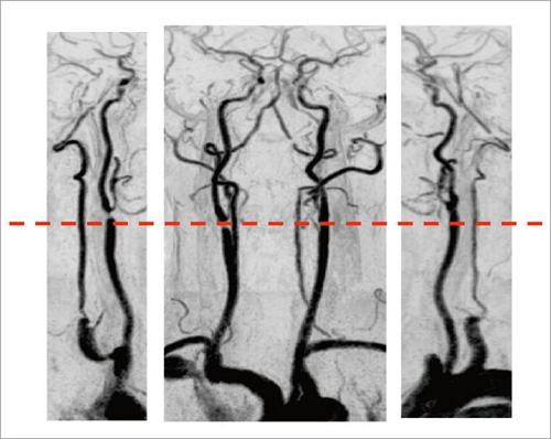 図11 頸部MRA(総頸動脈)