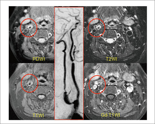 図12 頸部Plaque Imaging