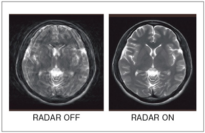 図4 RADARによるアーチファクト低減効果