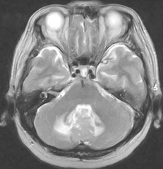 図3　第四脳室内髄膜種 67歳，女性。手術加療となった。 T2WI（脳ドック症例） 