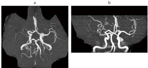 図4　右中大脳動脈閉塞 47歳，女性。SPECTの結果，Stage-Iでこのまま経過観察となった。 MRA，3D TOF，MIP像（脳ドック症例）