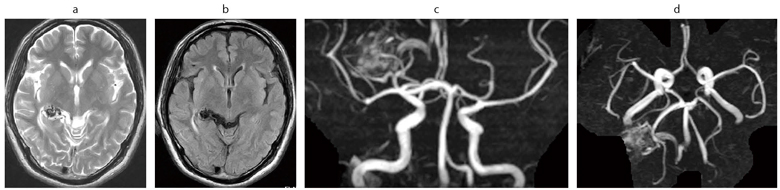 図5　左側頭葉AVM 42歳，男性。頭痛で来院し，経過観察中。 a：T2WI，b：FLAIR，c：MRA，3D TOF，MIP像（axial），d：MRA，3D TOF，MIP像（coronal）