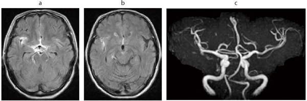 図6　右中大脳動脈瘤破裂によるクモ膜下出血例 72歳，女性。頭痛を主訴に独歩来院。 a，b：FLAIR c：MRA，3D TOF，MIP像