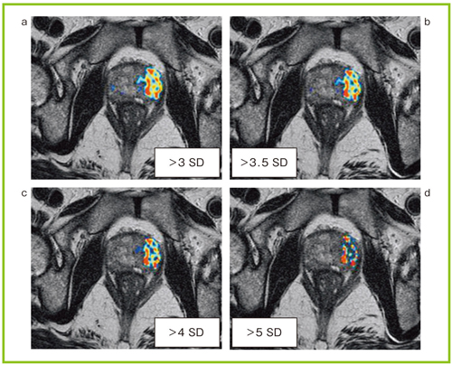 図5 Fusion rSIのSD値による描出能の比較