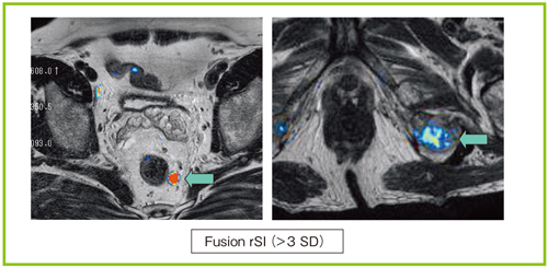 図6 Fusion rSIによる病変検出 リンパ節転移,骨転移病変も描出できる。