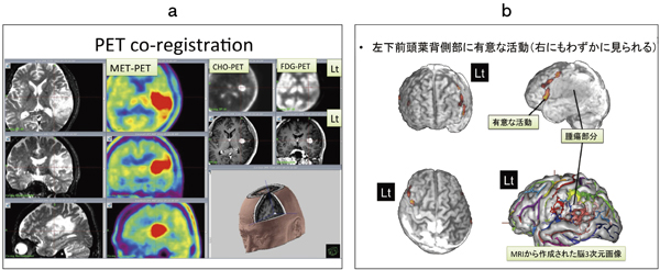 }3@pǑ摜 aFMRI3ނPET̗Z摜CbF@\MRIifMRIjƎO]摜