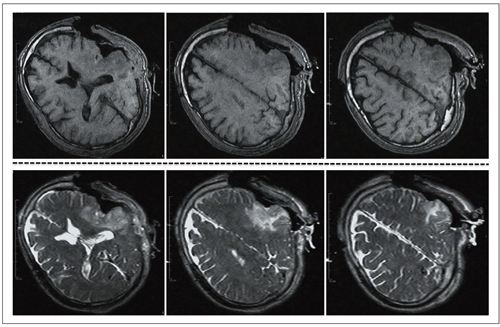 図5　摘出中の術中MRI画像（0.3TオープンMRI：AIRIS-II）　上段：T1WI，下段：T2WI（抜粋）　T2WIで腫瘍・摘出腔の一部は高信号（白）に明瞭に描出される。