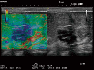 Real-time Tissue Elastography