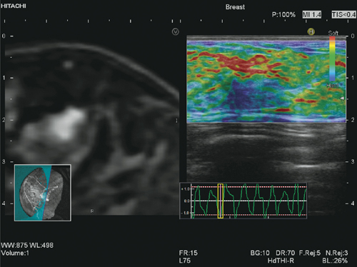 }4@BMR-RVS{Real-time Tissue Elastography
